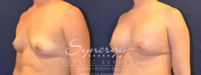 Before & After Breast Augmentation Case 357 View #5 View in Austin, TX