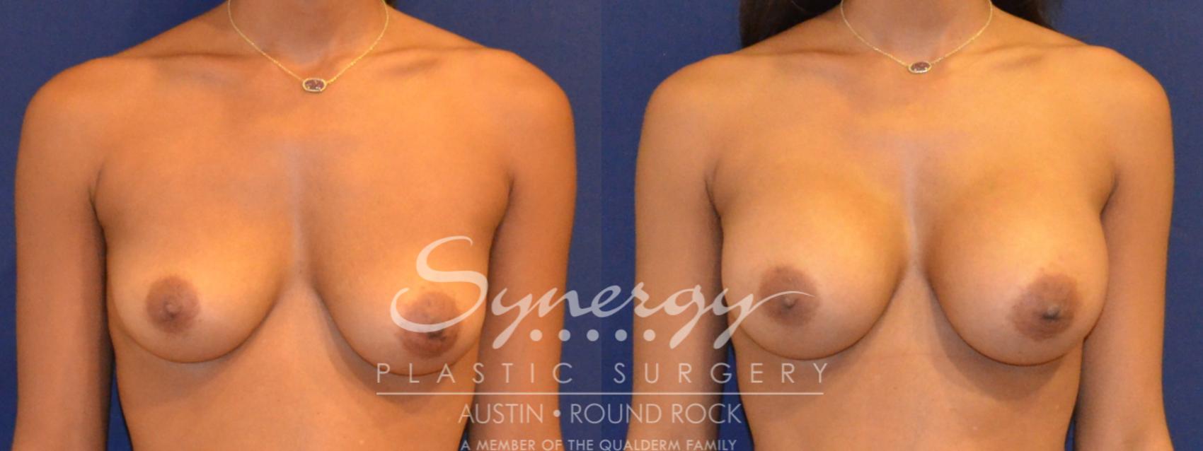 Before & After Breast Augmentation Case 358 View #1 View in Austin, TX