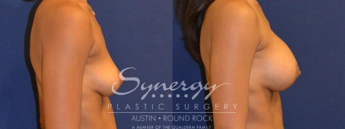 Before & After Breast Augmentation Case 358 View #2 View in Austin, TX