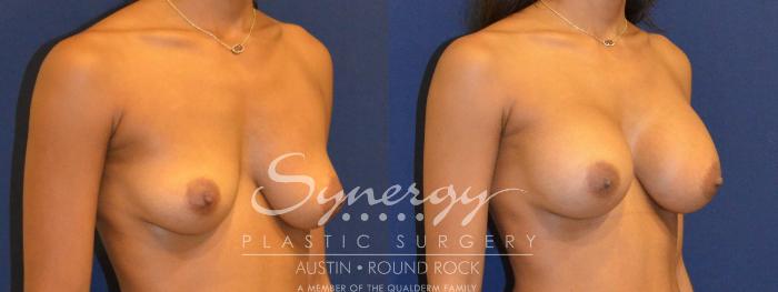 Before & After Breast Augmentation Case 358 View #3 View in Austin, TX