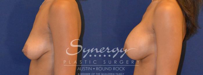 Before & After Breast Augmentation Case 358 View #4 View in Austin, TX