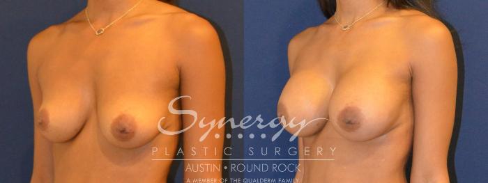 Before & After Breast Augmentation Case 358 View #5 View in Austin, TX