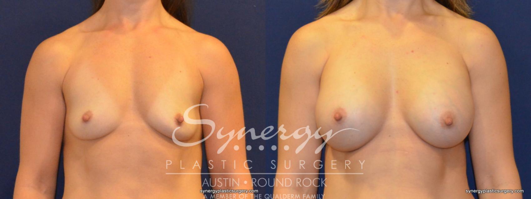Before & After Breast Augmentation Case 359 View #1 View in Austin, TX