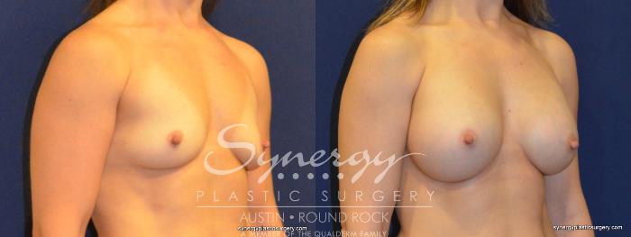 Before & After Breast Augmentation Case 359 View #3 View in Austin, TX