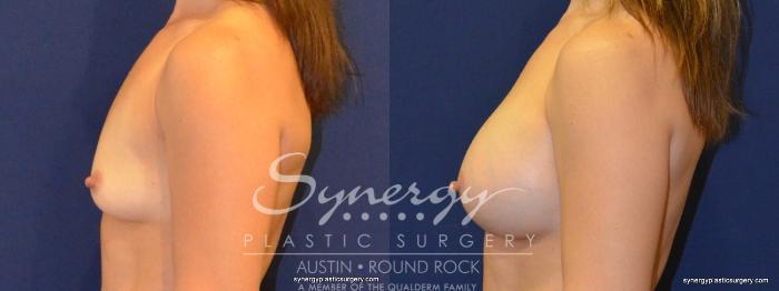 Before & After Breast Augmentation Case 359 View #4 View in Austin, TX