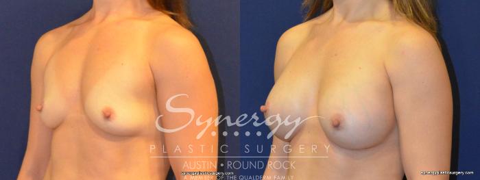 Before & After Breast Augmentation Case 359 View #5 View in Austin, TX