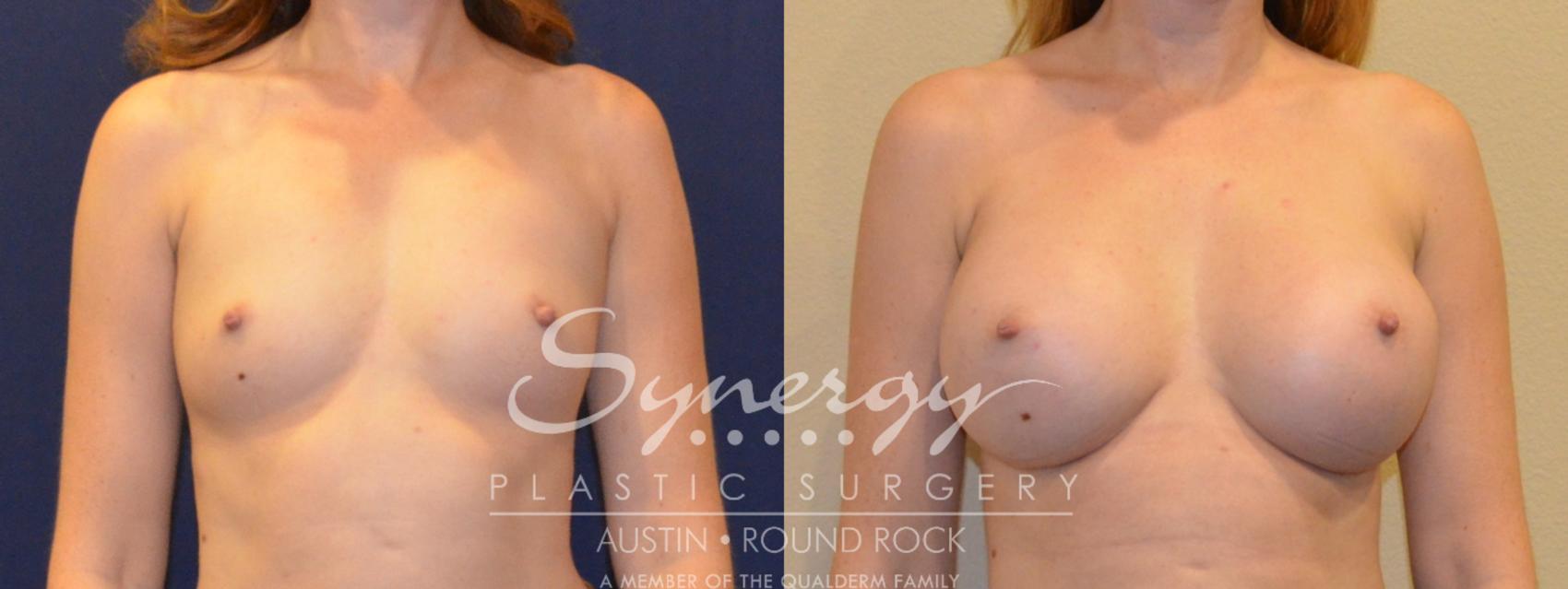 Before & After Breast Augmentation Case 361 View #1 View in Austin, TX