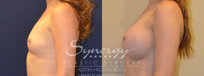 Before & After Breast Augmentation Case 361 View #2 View in Austin, TX