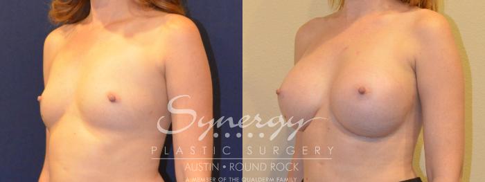 Before & After Breast Augmentation Case 361 View #3 View in Austin, TX