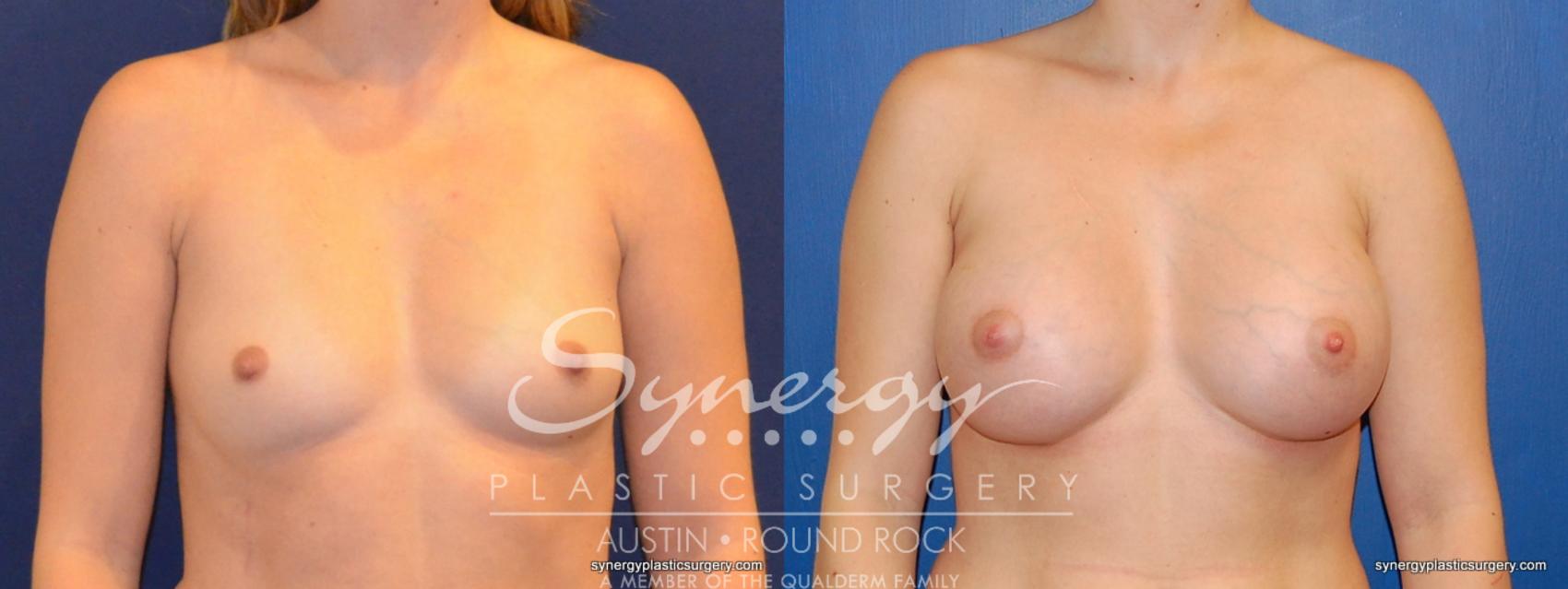 Before & After Breast Augmentation Case 373 View #1 View in Austin, TX