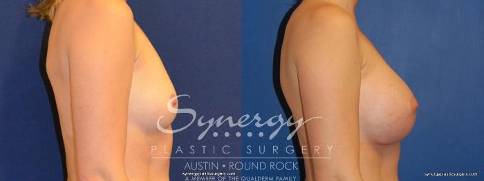 Before & After Breast Augmentation Case 373 View #2 View in Austin, TX