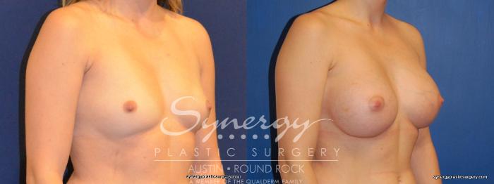 Before & After Breast Augmentation Case 373 View #3 View in Austin, TX