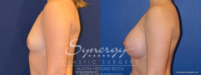 Before & After Breast Augmentation Case 373 View #4 View in Austin, TX
