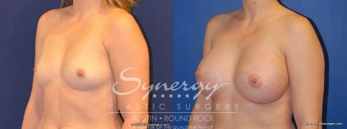 Before & After Breast Augmentation Case 373 View #5 View in Austin, TX