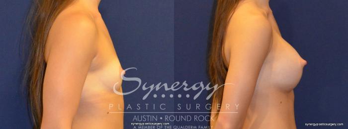Before & After Breast Augmentation Case 374 View #2 View in Austin, TX