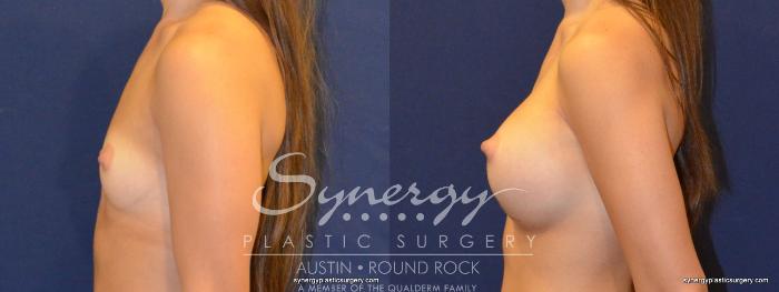 Before & After Breast Augmentation Case 374 View #4 View in Austin, TX
