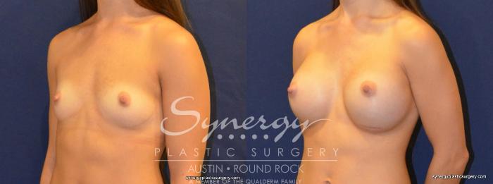 Before & After Breast Augmentation Case 374 View #5 View in Austin, TX