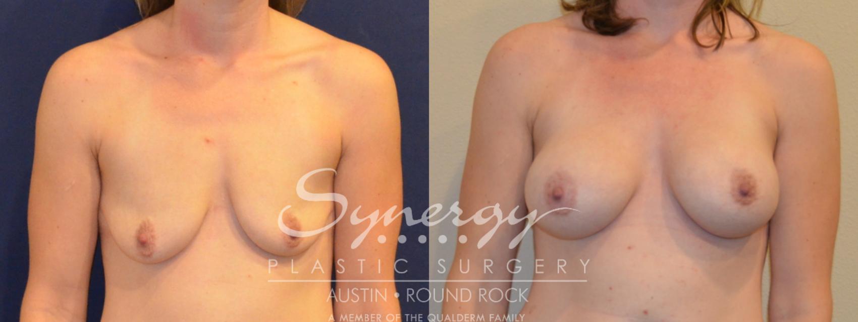 Before & After Breast Augmentation Case 379 View #1 View in Austin, TX
