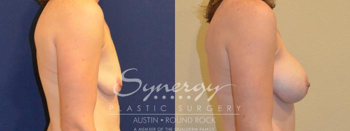 Before & After Breast Augmentation Case 379 View #2 View in Austin, TX
