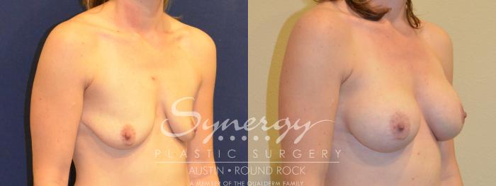 Before & After Breast Augmentation Case 379 View #3 View in Austin, TX