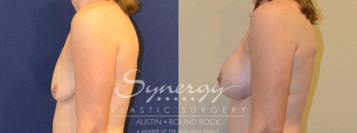Before & After Breast Augmentation Case 379 View #4 View in Austin, TX