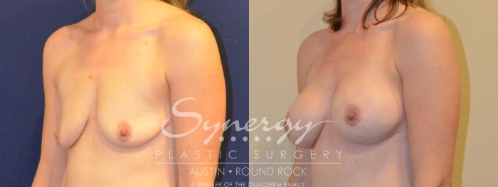 Before & After Breast Augmentation Case 379 View #5 View in Austin, TX