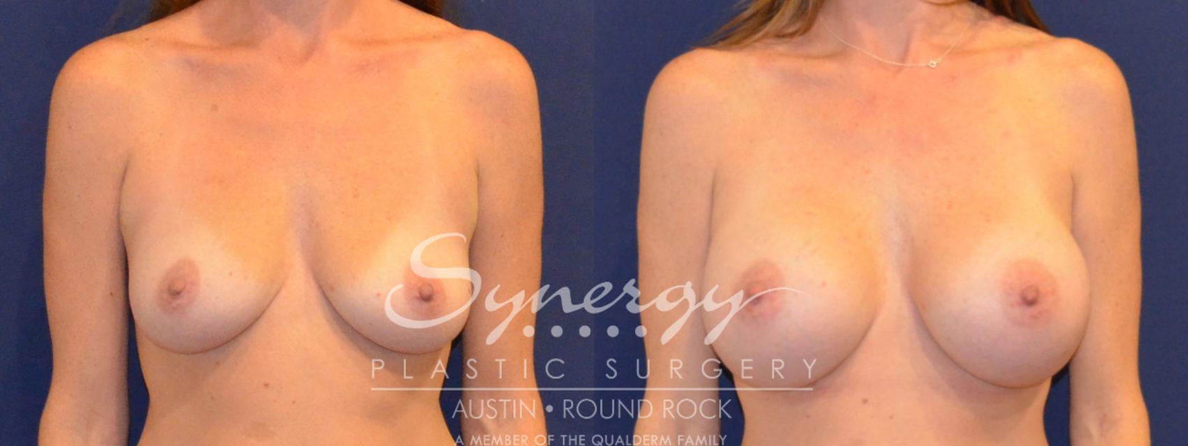 Before & After Breast Augmentation Case 386 View #1 View in Austin, TX