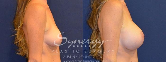Before & After Breast Augmentation Case 386 View #2 View in Austin, TX