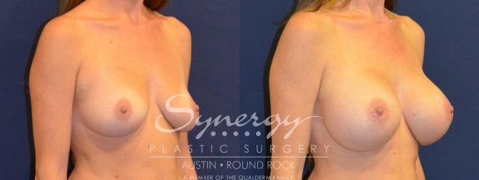 Before & After Breast Augmentation Case 386 View #3 View in Austin, TX