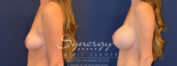 Before & After Breast Augmentation Case 386 View #4 View in Austin, TX