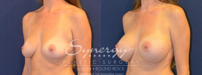 Before & After Breast Augmentation Case 386 View #5 View in Austin, TX