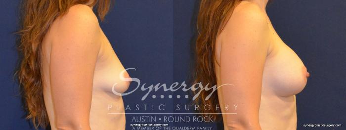 Before & After Breast Augmentation Case 390 View #2 View in Austin, TX