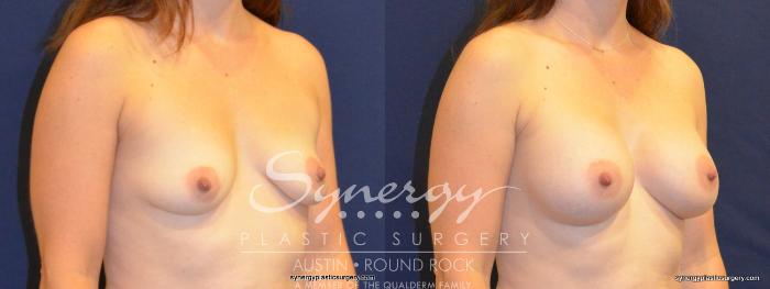 Before & After Breast Augmentation Case 390 View #3 View in Austin, TX