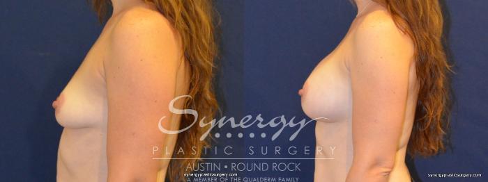 Before & After Breast Augmentation Case 390 View #4 View in Austin, TX