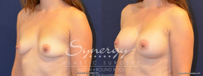Before & After Breast Augmentation Case 390 View #5 View in Austin, TX