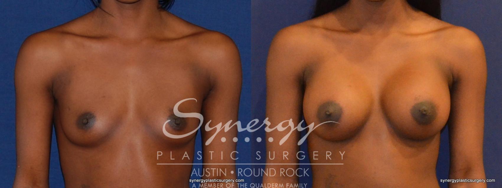 Before & After Breast Augmentation Case 397 View #1 View in Austin, TX