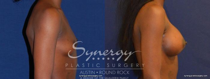 Before & After Breast Augmentation Case 397 View #2 View in Austin, TX