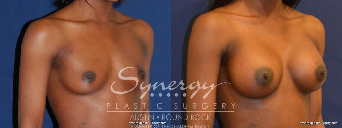 Before & After Breast Augmentation Case 397 View #3 View in Austin, TX