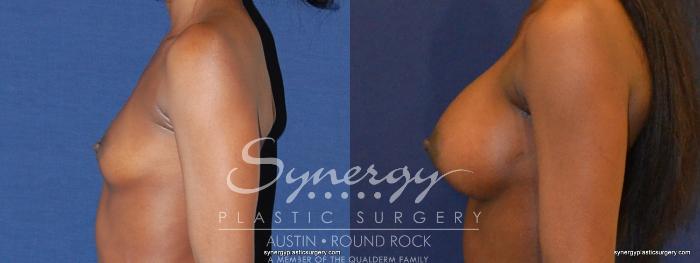 Before & After Breast Augmentation Case 397 View #4 View in Austin, TX