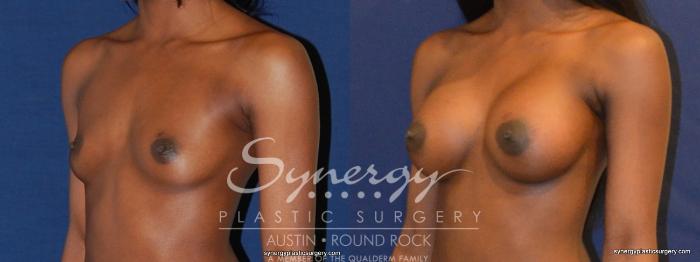 Before & After Breast Augmentation Case 397 View #5 View in Austin, TX