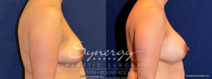 Before & After Breast Augmentation Case 402 View #2 View in Austin, TX