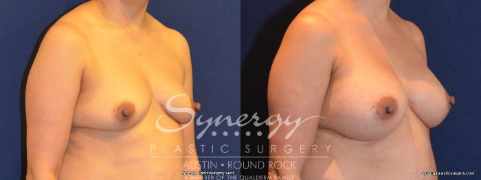 Before & After Breast Augmentation Case 402 View #3 View in Austin, TX