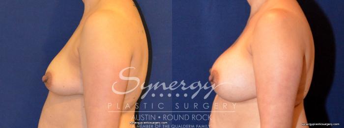 Before & After Breast Augmentation Case 402 View #4 View in Austin, TX