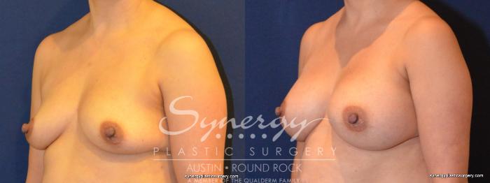 Before & After Breast Augmentation Case 402 View #5 View in Austin, TX
