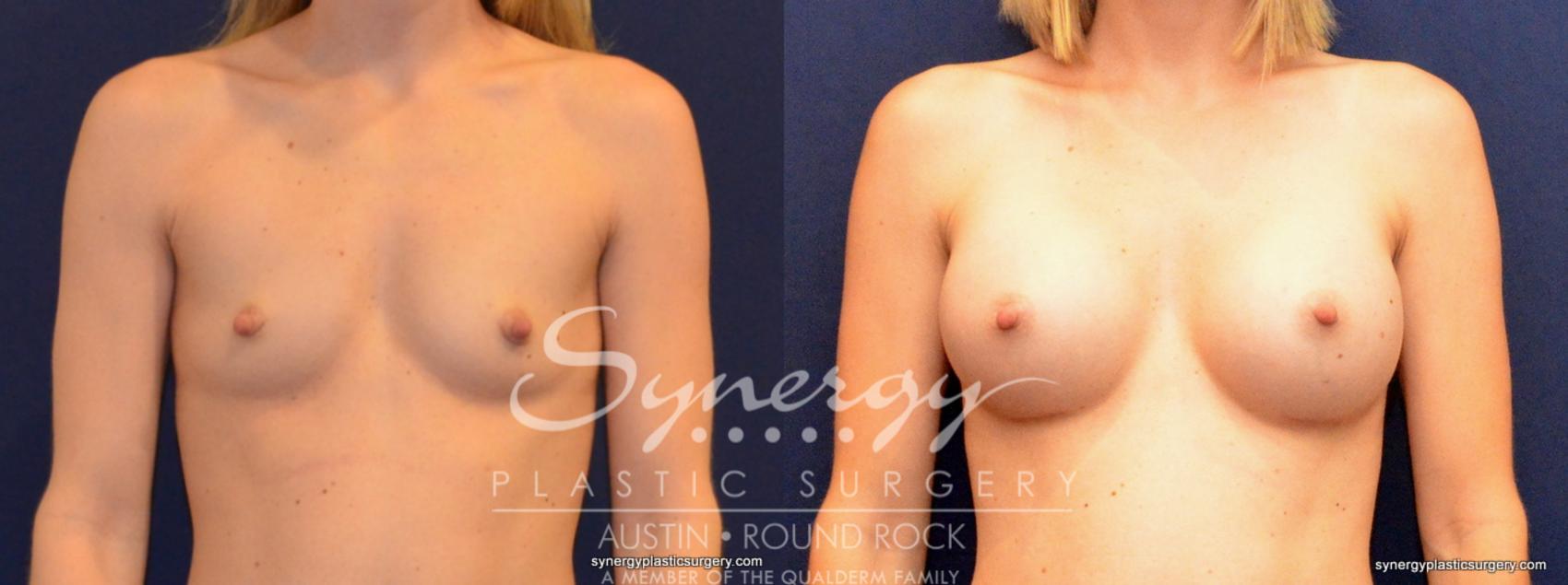 Before & After Breast Augmentation Case 403 View #1 View in Austin, TX
