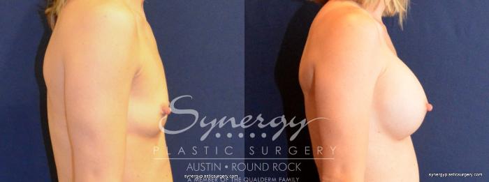Before & After Breast Augmentation Case 403 View #2 View in Austin, TX