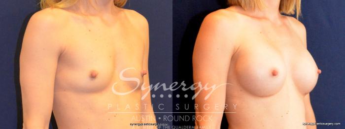 Before & After Breast Augmentation Case 403 View #3 View in Austin, TX
