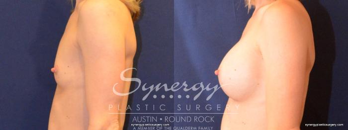 Before & After Breast Augmentation Case 403 View #4 View in Austin, TX