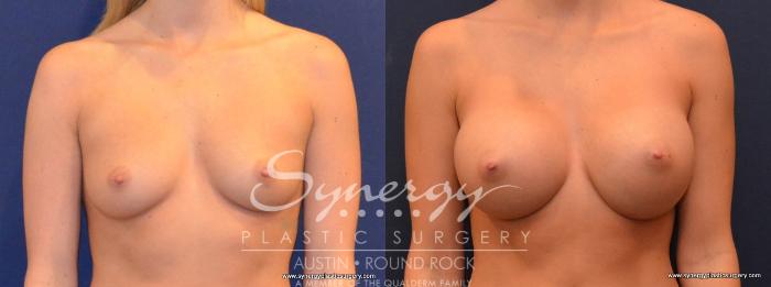 Before & After Breast Augmentation Case 405 View #1 View in Austin, TX