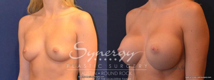Before & After Breast Augmentation Case 405 View #2 View in Austin, TX